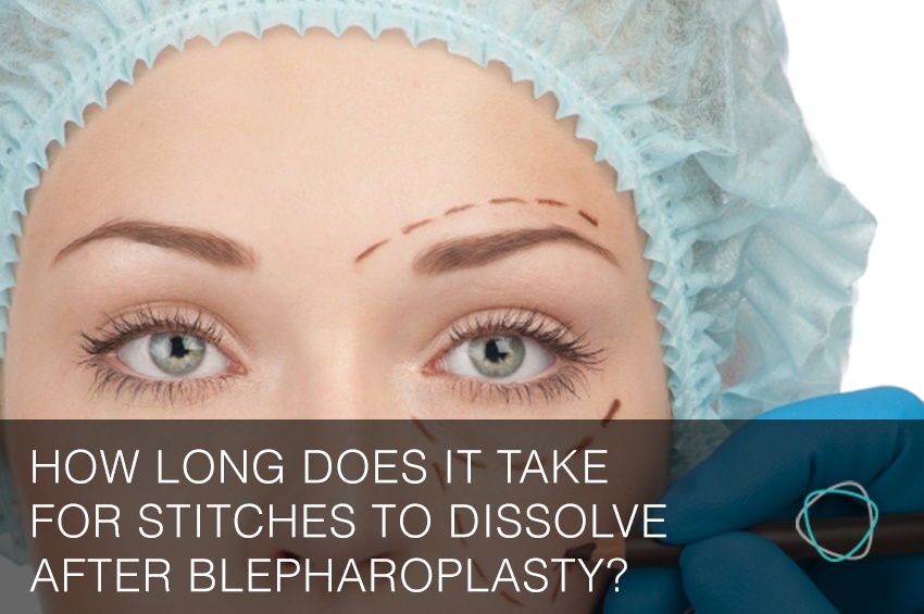 How long does it take for stitches to dissolve after blepharoplasty?