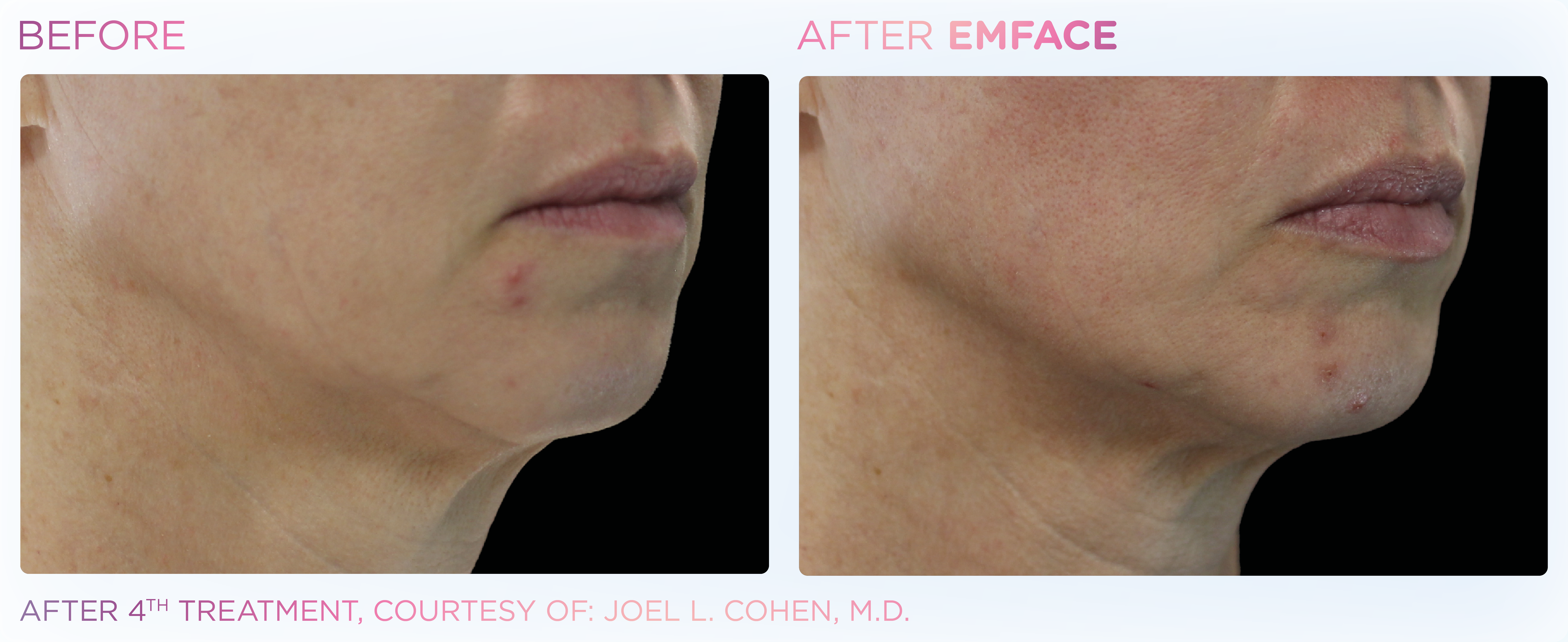 Emface_PIC_Ba-card-female-jawline-059_ENUS100