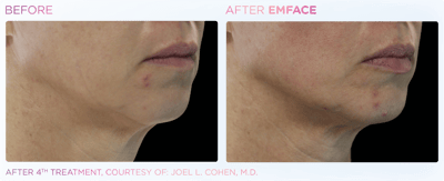 Emface_PIC_Ba-card-female-jawline-059_ENUS100