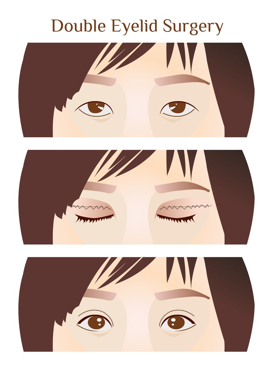 Asian Double Eyelid Procedure