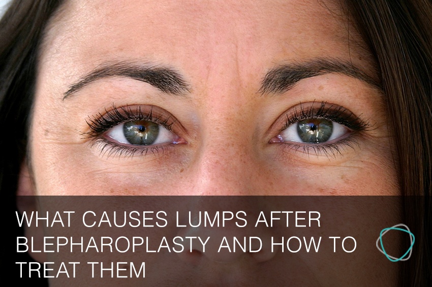 blepharoplasty lumps causes eyelid surgery treat them